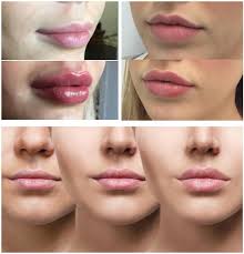 plump lips with hyaluronic acid