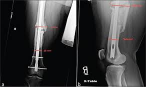nonunion in femur and tibia fractures