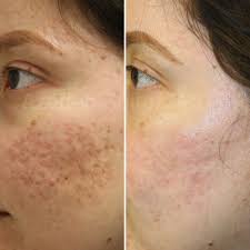 subcision for your acne scars