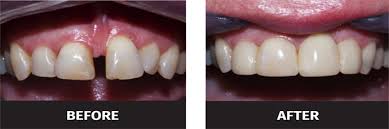 Bonded retainers these are small wires that are glued to the back of teeth to prevent them moving after the braces have been removed. Black Triangle Teeth Treatment Uk