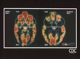 Image result for comparison of trauma child brain