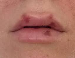 pain 72 hours after lip filler