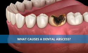 what causes a dental abscess