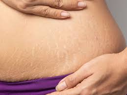 white stretch marks treatments causes