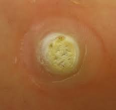 However, many photos of warts, especially plantar warts, could be considered disturbing to some readers. Plantar Wart Wikipedia