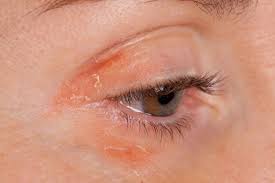 psoriasis eyes symptoms conditions