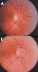 52 anterior ischemic optic neuropathy (aion) is an eye disease characterized by infarction of the optic disk leading to vision loss. Nonarteritic Anterior Ischemic Optic Neuropathy Desai 2005 The Journal Of Clinical Hypertension Wiley Online Library