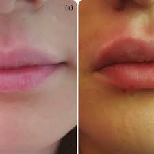 injection technique for lip augmentation