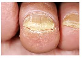 how to handle toenail fungus stamford