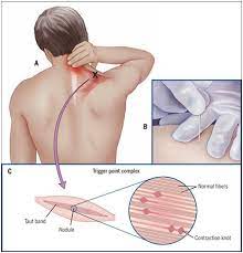 trigger point dry needling physical