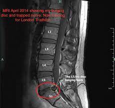 can a physio have a slipped disc can