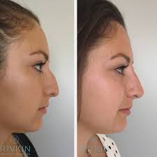 Don't touch or rub the treated area for at least six hours after treatment. Before And After Nose Injections To Mask The Hump Of Her Nose Even Though We Are Adding Filler It Creates An Illusion And Makes Her Nose Loo Rinoplastia Nariz