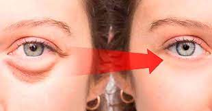 bags under the eyesi natural treatments