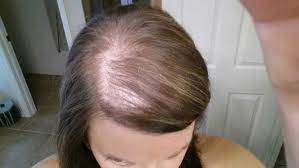 hair fall after delivery dr walia s