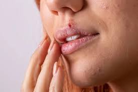 herpes lips images