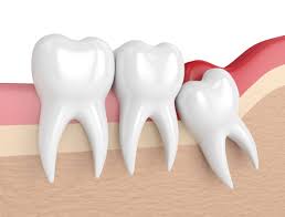 sensitive teeth after wisdom tooth