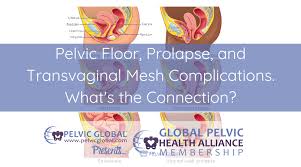 pelvic floor prolapse and