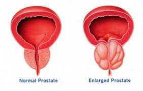 What Is Benign Prostatic Hyperplasia (BPH)? | QProstate