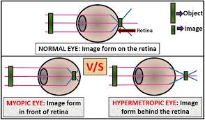 Difference Between Myopia And Hypermetropia With Comparison