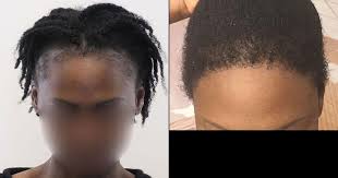 Diep has overcome these challenges with some specific modifications to ensure. Before After Photos Hair Transplant Turkey Aek Hair Clinic