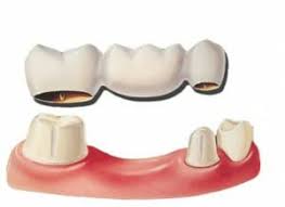 3 common problems with dental bridges