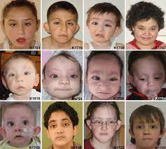 faces of mll2 mutation positive