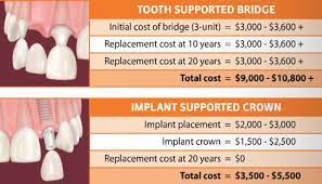 dental bridge versus dental implant