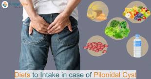 ts to intake in case of pilonidal cyst