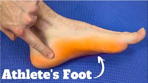 foot fungus apple cider vinegar cure