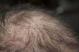 topical minoxidil reverses hair loss