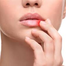 cold sores dermatologist in kinnelon