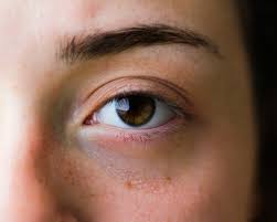 eye makeup tips after eyelid surgery