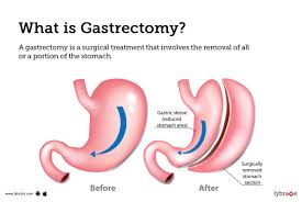 gastrectomy causes symptoms