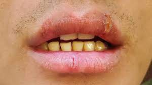 chapped lips cheilitis simplex