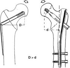 intertrochanteric hip fracture