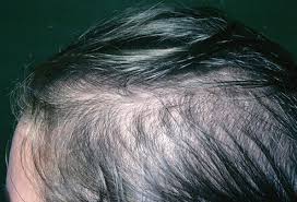 The hair growth rate slows down as people age and is called alopecia. Hair Loss Treatment Causes Types Home Remedies Prevention