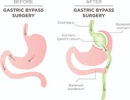 best gastric byp treatment