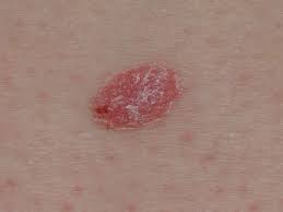 That's why it's so important to be vigilant, as the disease is very treatable if you catch it early. Psoriasis Or Skin Cancer How To Tell The Difference