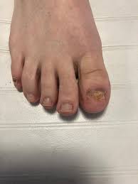 is toenail fungus painful why you
