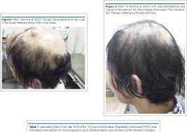 Just wanted to pass some positive information on and see what you guys think. Successful Treatment Of Multiple Alopecia Areata With Contact Immunotherapy Supportive Usage Of Oral Antihistamine And Topical Corticosteroid Semantic Scholar