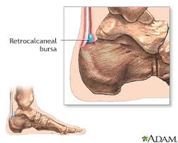 leg pain information mount sinai