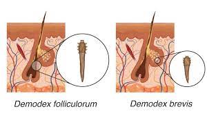 ungex human hair mite demodex treatment
