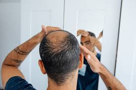 minoxidil for hair loss what to know