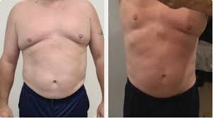 men body contouring before and after