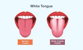 white tongue symptoms causes