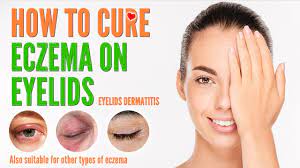 how to cure eczema on eyelids eyelids