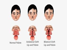 cleft lip and palate surgery cost in india