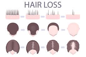 This could be yourself or someone close. Hair Loss Who Gets And Causes