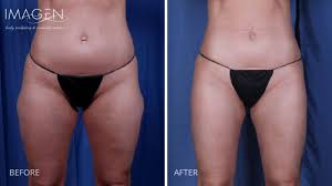 thighs liposuction by imagen body sculpting