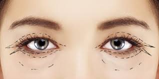 blepharoplasty eye surgery bellevue